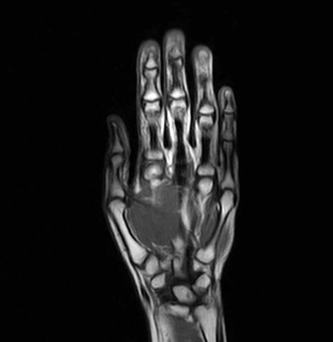 Hand MRI scan
